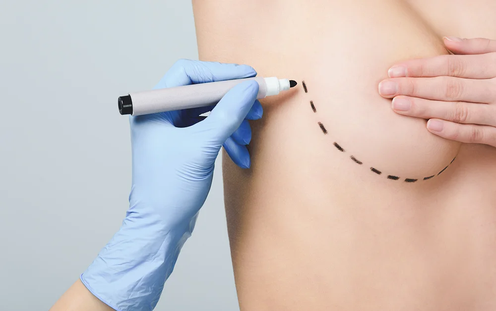 3 Types Of Breast Augmentation Incisions